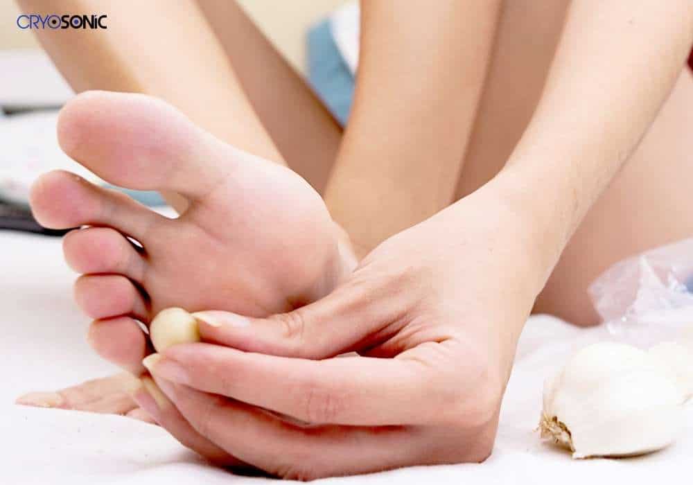 Are all warts connected to HPV? - cryosonic.co.uk Solihull