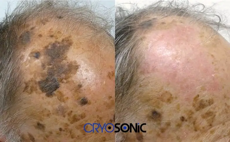 Why Do We Ignore Seborrheic Keratosis — And Then Regret It Solihull
