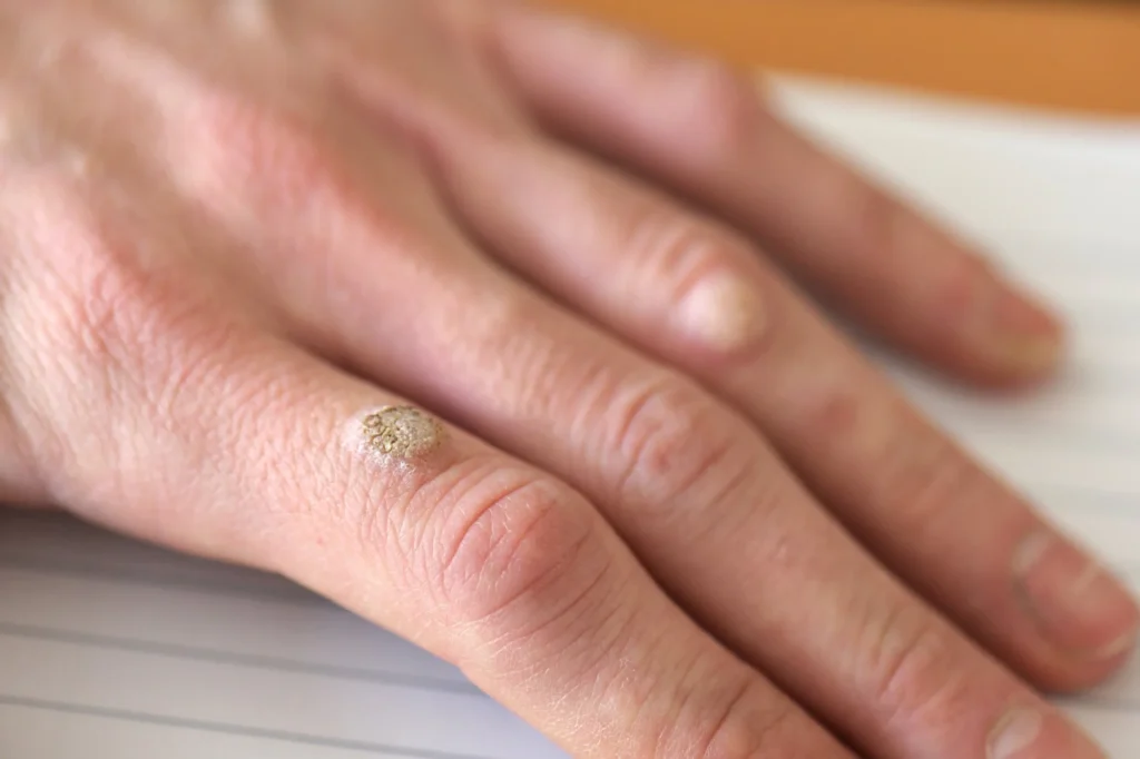 FAQs – Do Warts Return After CryoPen Treatment Solihull